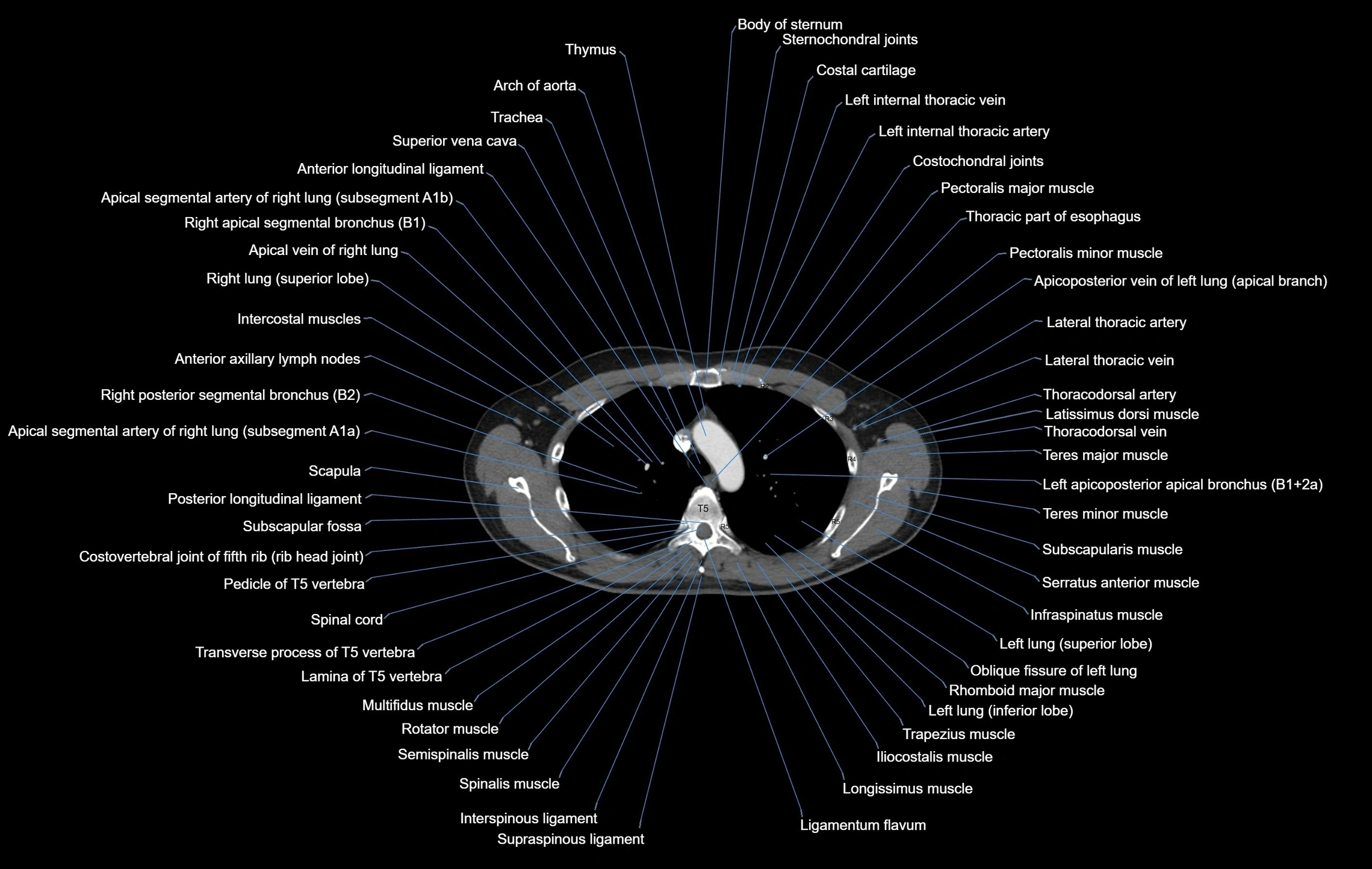 CT chest (thorax) labelled axial cross sectional anatomy radiology image-00036.webp